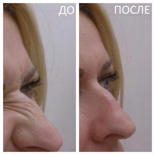 Когда подействует ботокс в межбровье. Основные показания к применению Ботокса 03