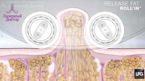 Роликово вакуумный массаж. Вакуумно-роликовый массаж: описание процедуры 06