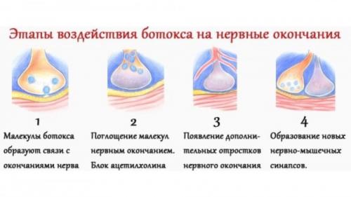 Ботокс для лица до и после. Инъекции ботокса: ответы на самые популярные вопросы к косметологу 01 Ботокс для лица до и после. Инъекции ботокса: ответы на самые популярные вопросы к косметологу 01