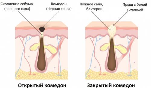 Лечения комедонов на лице народными методами. Народные средства и рецепты 03 Лечения комедонов на лице народными методами. Народные средства и рецепты 03