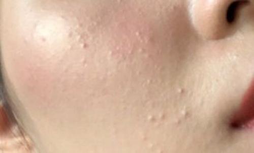 Чем опасны закрытые комедоны 02 Чем опасны закрытые комедоны 02