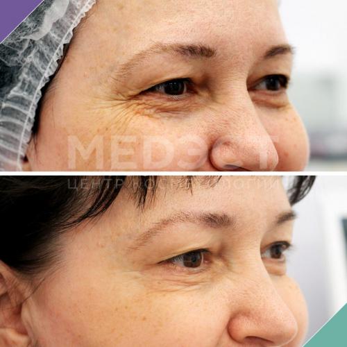 Убрать морщины под глазами косметология цены. Все способы избавиться от морщин вокруг глаз