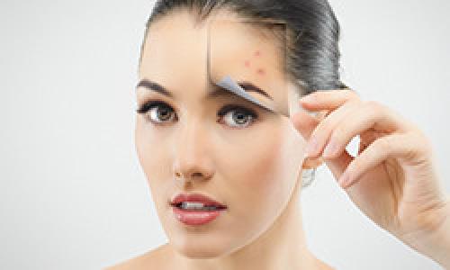 Убрать следы от прыщей на щеках. Чистая кожа раз и навсегда! Как победить акне?