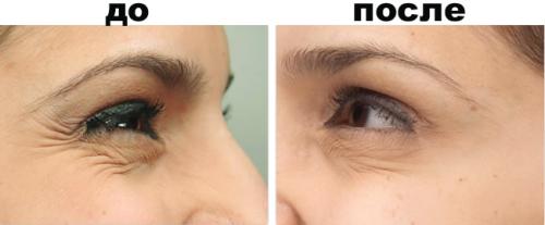 Как избавиться от гусиных лапок под глазами. Как убрать гусиные лапки вокруг глаз