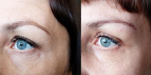 Сухая кожа под глазами морщины. Самые частые проблемы кожи вокруг глаз 07 Сухая кожа под глазами морщины. Самые частые проблемы кожи вокруг глаз 07