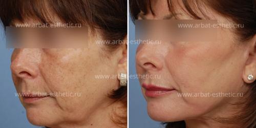 Как избавиться от гусиной кожи под глазами. Как убрать гусиные лапки вокруг глаз 05