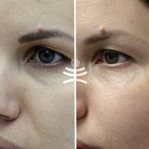 Убрать мимические морщины вокруг глаз. Все способы избавиться от морщин вокруг глаз