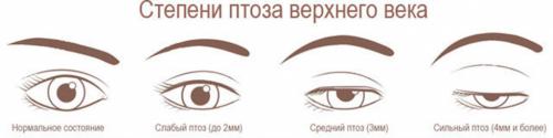 Опустились веки после ботокса. Что такое опущенное веко или бровь (птоз) из-за ботокса? 01 Опустились веки после ботокса. Что такое опущенное веко или бровь (птоз) из-за ботокса? 01