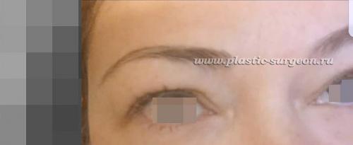 Сухость глаз после ботокса. Причины птоза 04 Сухость глаз после ботокса. Причины птоза 04