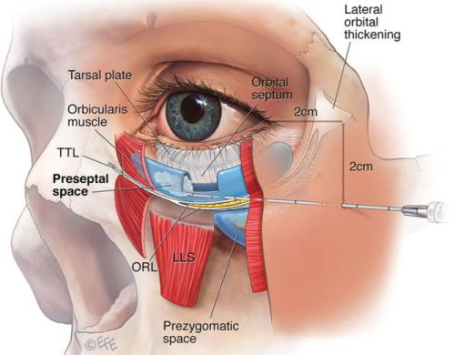Лучший крем от темных кругов под глазами. Как убрать круги филлерами.