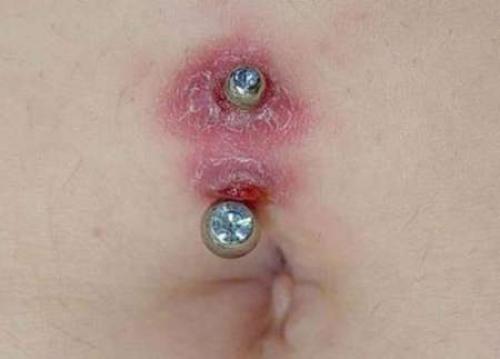 Чем заменить пирсинг в пупке при беременности. Пирсинг пупка и беременность: когда снимать и как сохранить