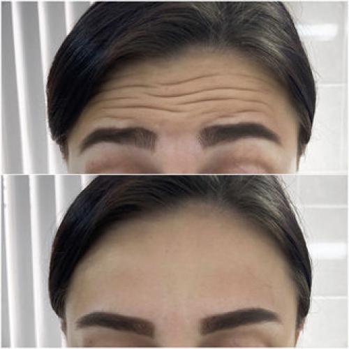 Понимание дозы: Как выбрать оптимальное количество диспорта для лба и межбровки 01