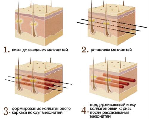 Мезонити это, что. Какие виды мезонитей бывают 03 Мезонити это, что. Какие виды мезонитей бывают 03