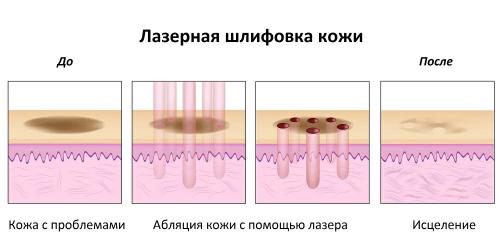 Все, что нужно знать о лазерном фракционном омоложении 01 Все, что нужно знать о лазерном фракционном омоложении 01