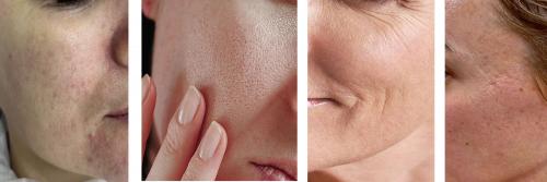 Какие результаты можно ожидать после лазерного фракционного омоложения. Кому показано лазерное омоложение кожи лица?