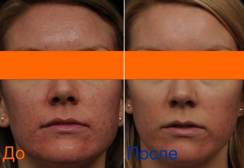 Сколько времени требуется на одну процедуру лазерного фракционного омоложения. Фракционное омоложение кожи