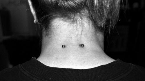 Тоннель в мочке уха. Пластика мочки уха 02