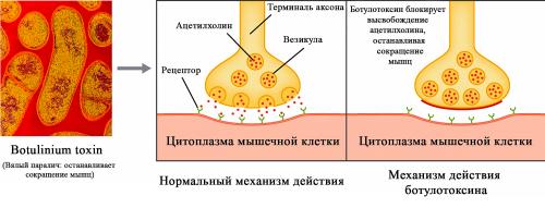 Какие факторы влияют на глубину введения ботулотоксина. Что представляет собой ботулинотерапия? Принцип действия