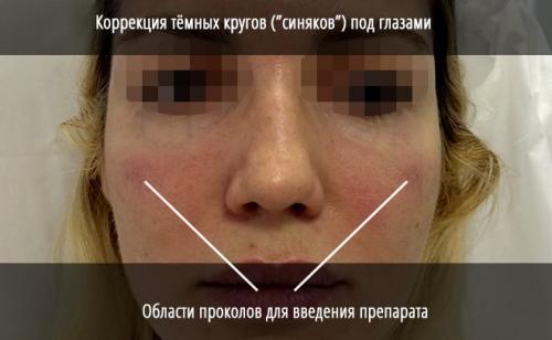 Уколы от мешков под глазами: эффективный способ устранить проблему 02 Уколы от мешков под глазами: эффективный способ устранить проблему 02