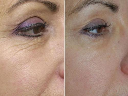 Уколы от мешков под глазами: эффективный способ устранить проблему 06 Уколы от мешков под глазами: эффективный способ устранить проблему 06