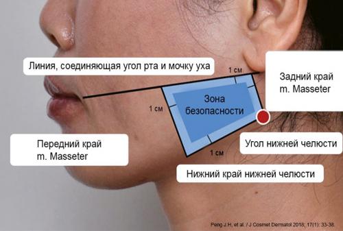 Ботокс в жевательные мышцы. Коррекция Ботоксом жевательных мышц лица 01