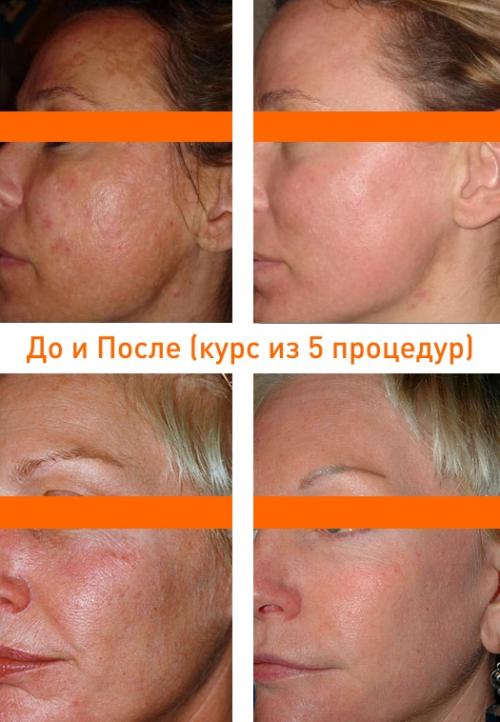 Какие проблемы кожи могут быть устранены с помощью процедуры Фраксель. Что такое лазерное омоложение fraxel ?