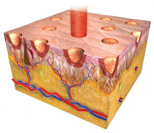 Как фракционные лазеры используются в медицине. Фракционные лазеры