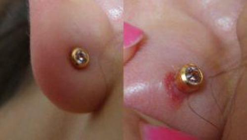 Что делать если загноился прокол в ухе. О детском пирсинге 07