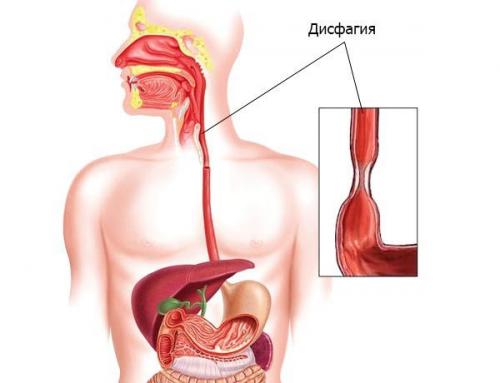 Боль при глотании. Боль в горле при глотании 03 Боль при глотании. Боль в горле при глотании 03