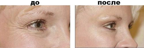 Что такое ботокс