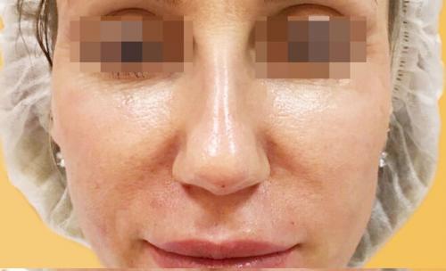 Сужение крыльев носа ботоксом. Описание