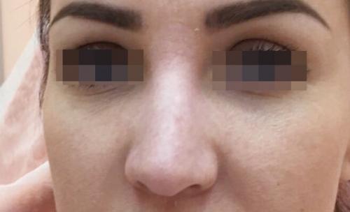 Сужение крыльев носа ботоксом. Описание
