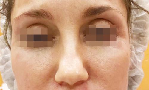 Сужение крыльев носа ботоксом. Описание