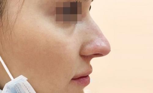Сужение крыльев носа ботоксом. Описание