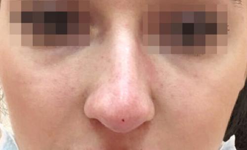 Сужение крыльев носа ботоксом. Описание