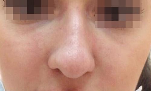 Сужение крыльев носа ботоксом. Описание