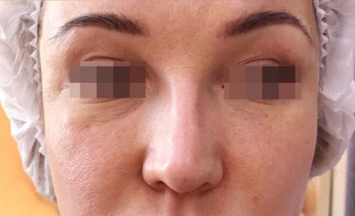 Сужение крыльев носа ботоксом. Описание