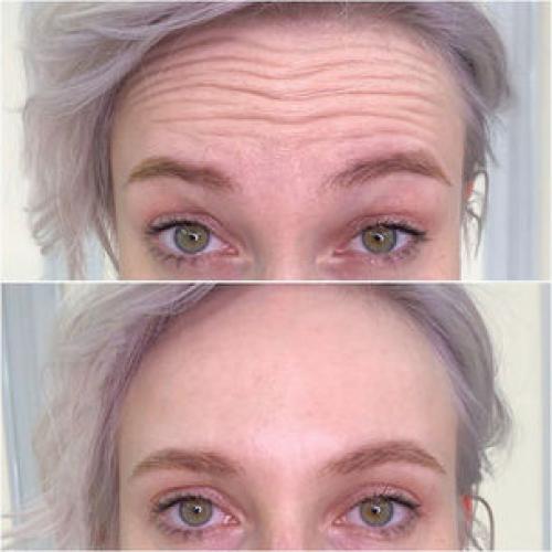 Подробно о количестве ботокса для лба и межбровья 01