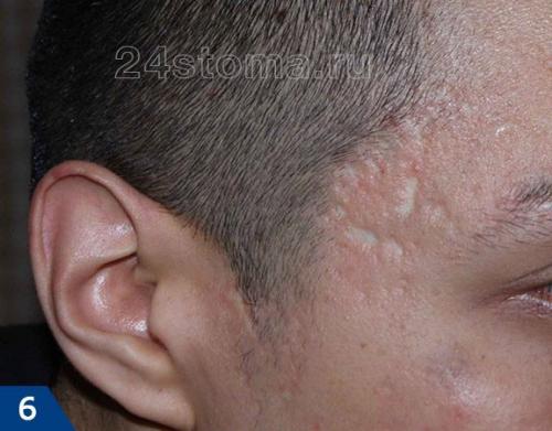 Самое лучшее средство от шрамов после прыщей. Виды шрамов (рубцов)  –