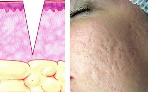 Как избавиться от рубцов на лице. Причины появления и области локализации постакне 05