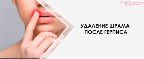 Как избавиться от шрамов на спине. Удаление шрамов на лице