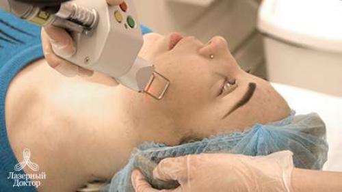 Как убрать следы постакне на лице. Что такое постакне? 04