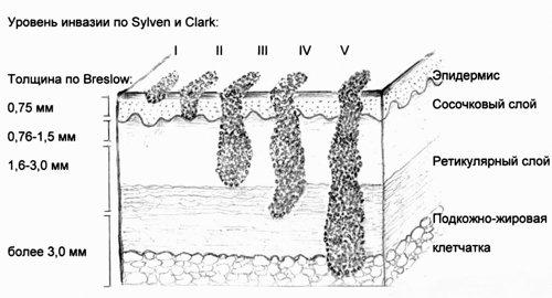 В чем разница между липомой и атеромой и нужно ли их удалять. Атерома и Липома – в чем разница? 06