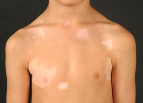 Сухие пятна на коже. Что такое актинический кератоз? 02 Сухие пятна на коже. Что такое актинический кератоз? 02