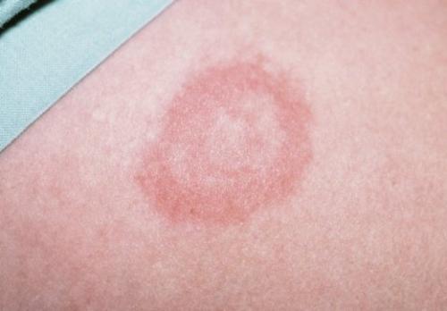 Сухие пятна на коже. Что такое актинический кератоз? 05 Сухие пятна на коже. Что такое актинический кератоз? 05