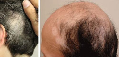 Сухие пятна на коже. Что такое актинический кератоз? 03 Сухие пятна на коже. Что такое актинический кератоз? 03