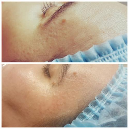 Как избавиться от постакне. Как бороться с последствиями акне? 02