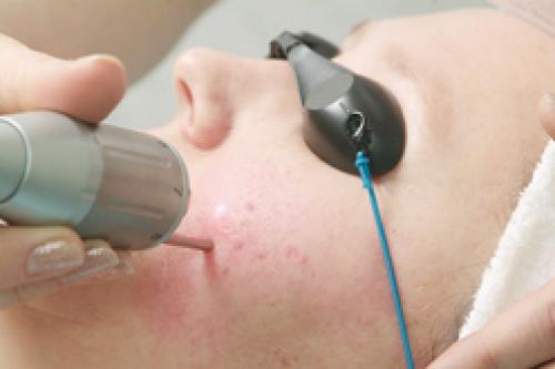 Как избавиться от постакне. Как бороться с последствиями акне? 01