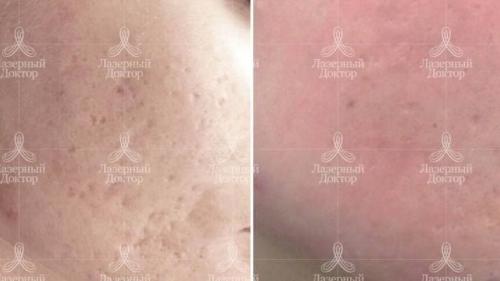 Как справиться с постакне. Избавление от постакне: процедура 01 Как справиться с постакне. Избавление от постакне: процедура 01