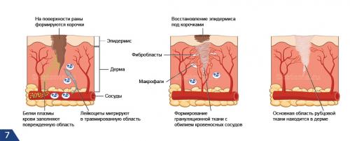 Чем мазать шрам, чтобы рассосался. Как происходит образование рубцов  –
